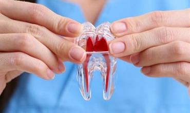 افسانه هایی درباره درمان کانال ریشه دندان